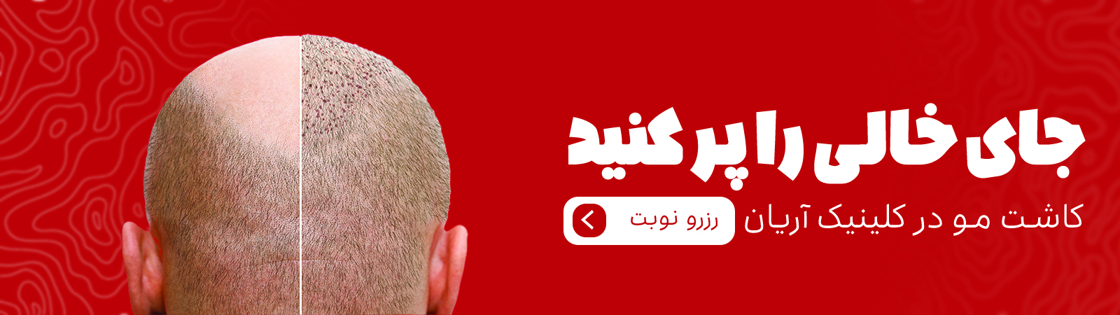 کاشت مو copy