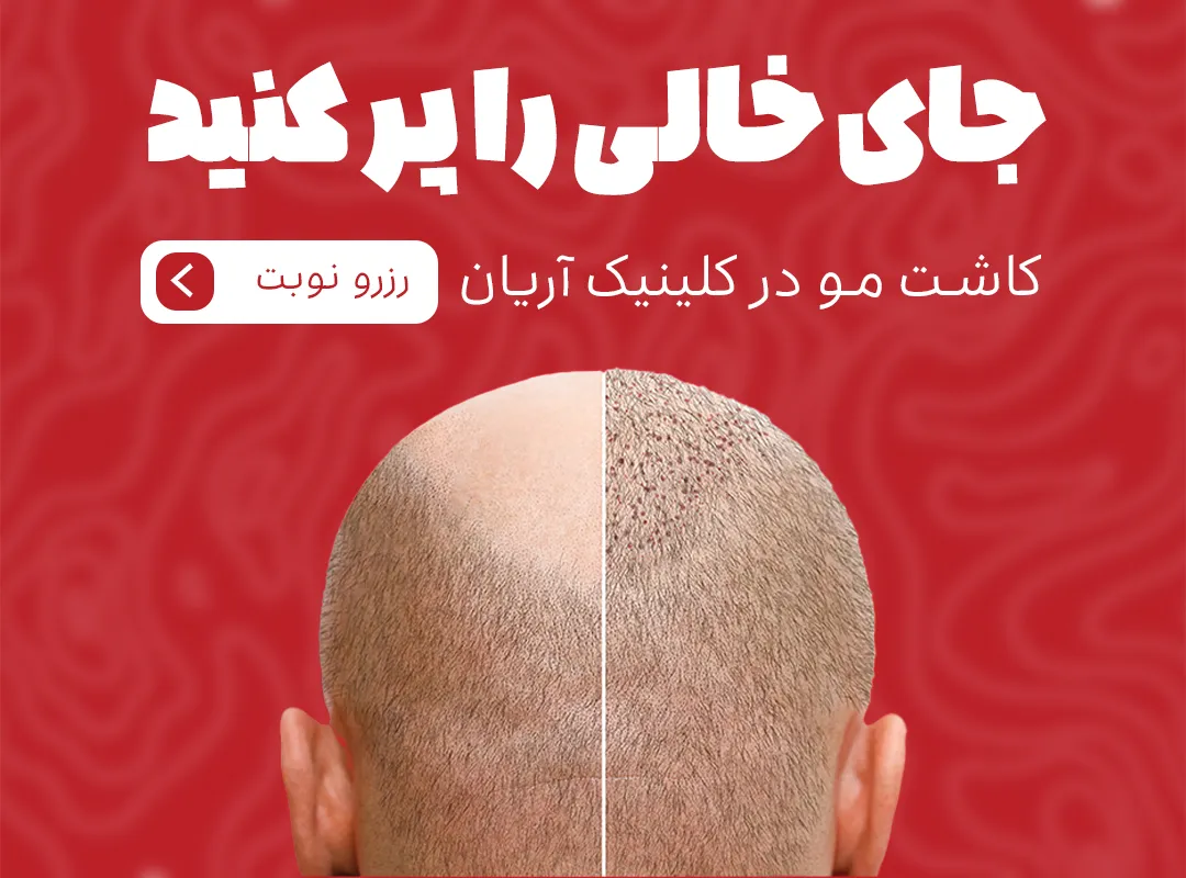 کاشت-مو-موبایل